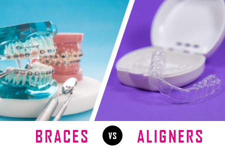 How to Decide Between Braces and Clear Aligners (featured image)