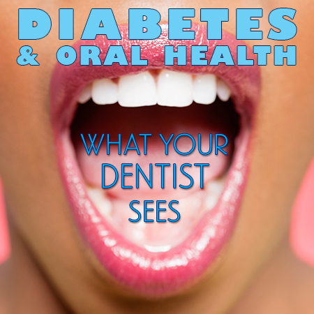 Diabetes & Oral Health: What Your Dentist Sees (featured image)