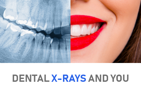 Dental X-rays and You; Everything You Need to Know (featured image)