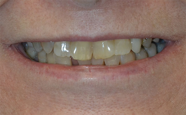Teeth Gapping Before