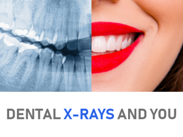 Dental X-rays and You; Everything You Need to Know (featured image)