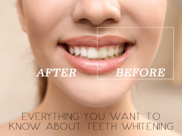 Everything You Want to Know About Teeth Whitening (featured image)