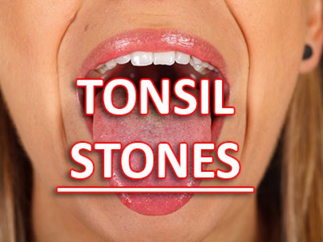 Suffering with a Sore Throat & Bad Breath? You Might Have Tonsil Stones (featured image)